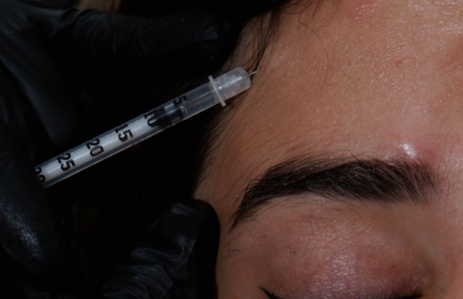 Choosing the Best Wrinkle Relaxers: Botox, Xeomin, and Dysport