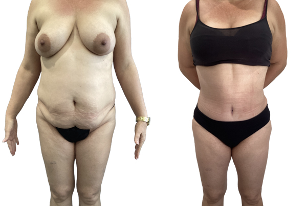 Abdominoplasty