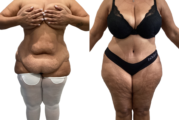 Abdominoplasty