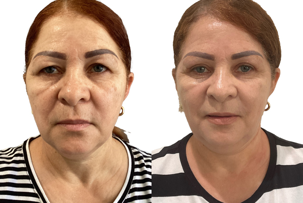 Blepharoplasty