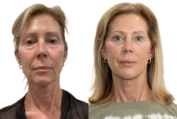 Blepharoplasty