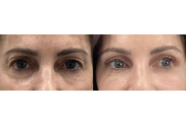 Blepharoplasty