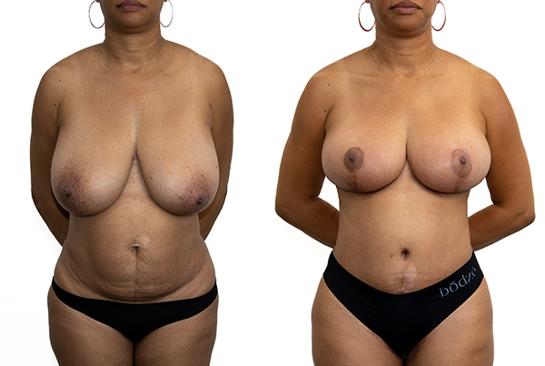 Breast Reduction