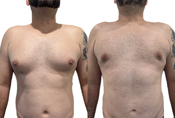 Gynecomastia
