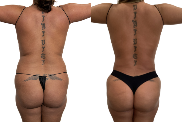 Brazilian Butt Lift