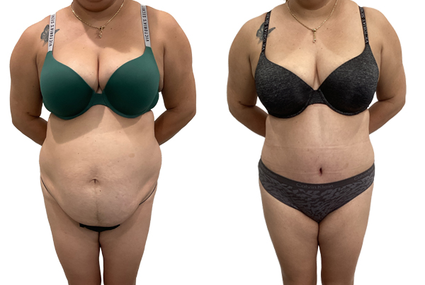 Abdominoplasty