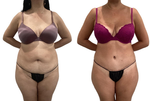 Abdominoplasty