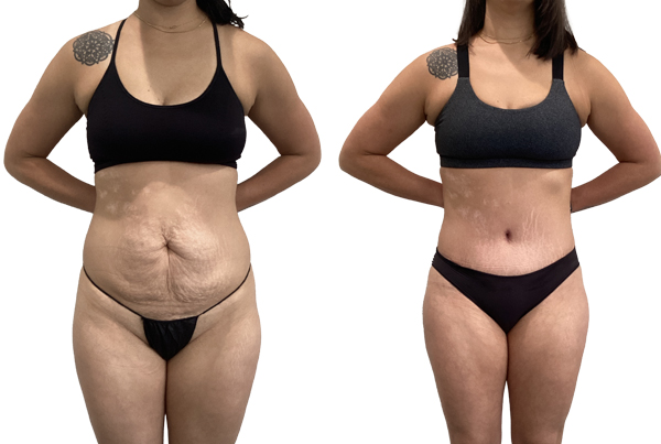 Abdominoplasty