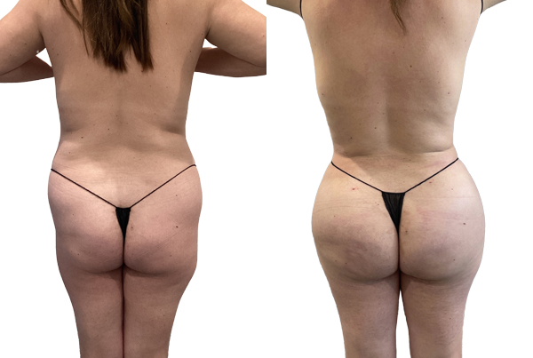 Brazilian Butt Lift