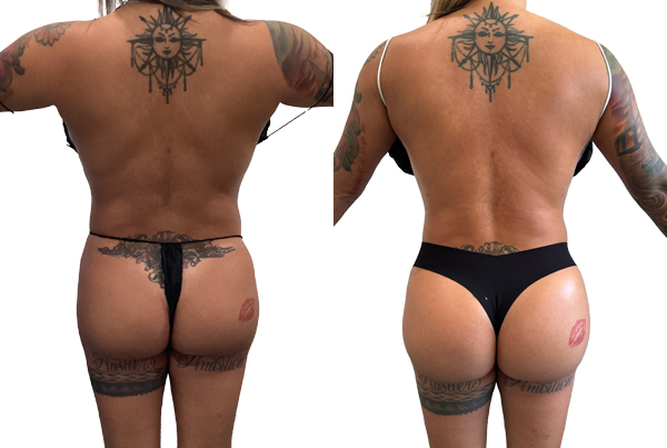 Brazilian Butt Lift