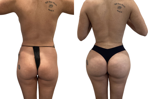 Brazilian Butt Lift