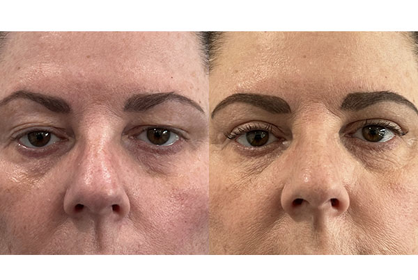 Blepharoplasty