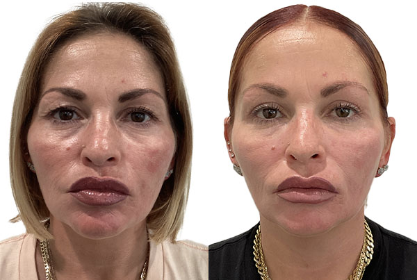 Blepharoplasty