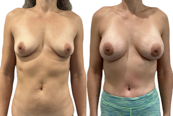 Breast Augmentation
