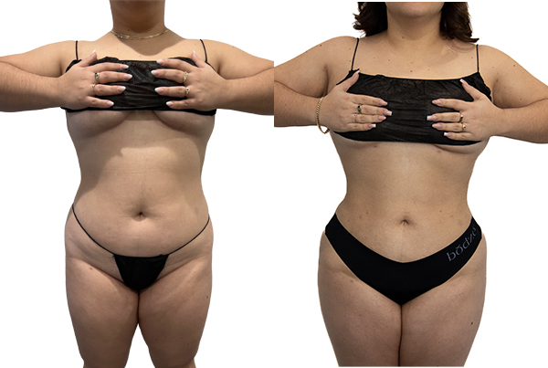 Liposuction 360
