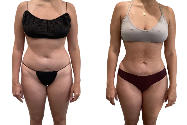 Liposuction 360