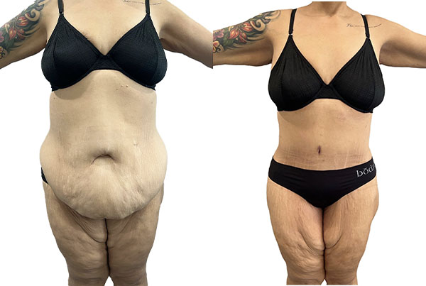 Abdominoplasty
