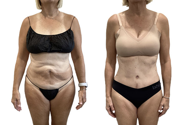 Abdominoplasty