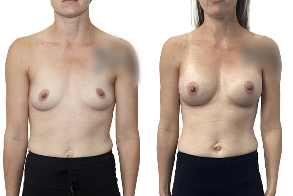 Breast Augmentation