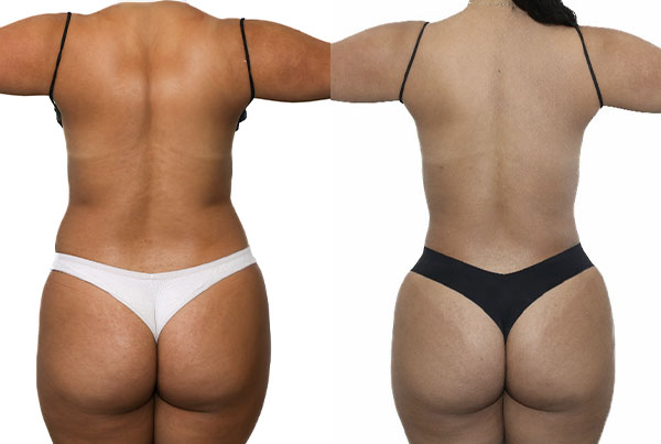 Brazilian Butt Lift