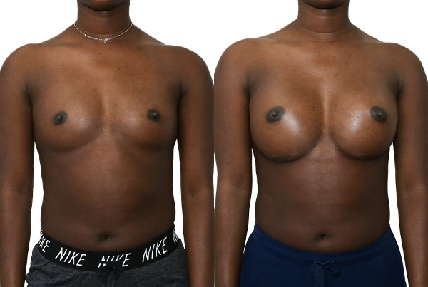 Breast Augmentation