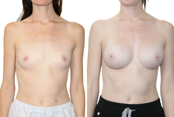 Breast Augmentation
