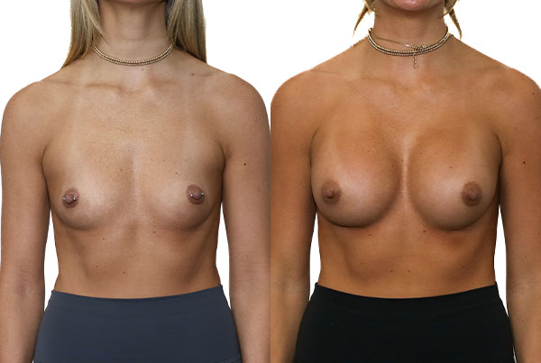 Breast Augmentation
